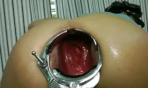 speculum prolapse le ...